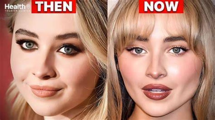 The Surprising Truth About Sabrina Carpenter's Fillers